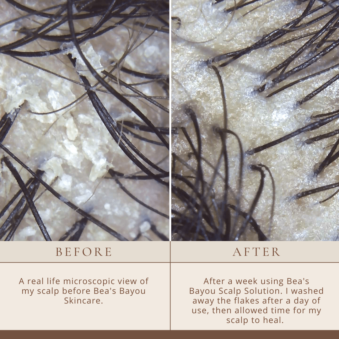 Seborrheic Scalp Solution | Herbal Leave-in | YeastDefense®️